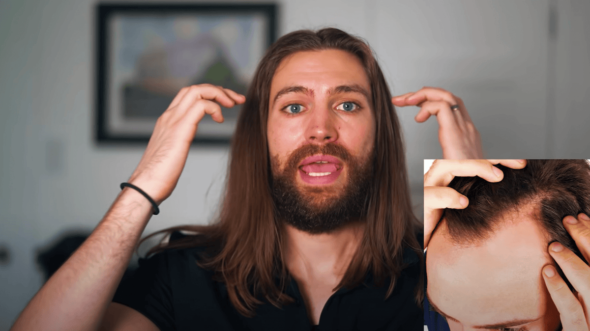Can You Grow Long Hair With A Receding Hairline?