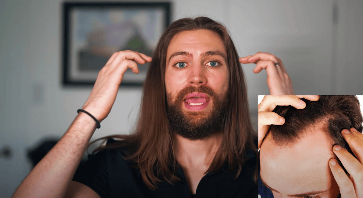 Can You Grow Long Hair With A Receding Hairline?